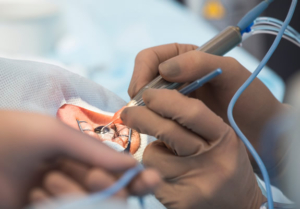 Oculoplastic Surgery North Dallas